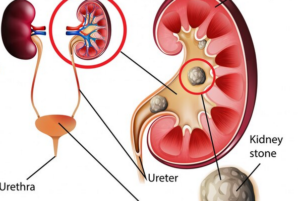 سنگ مجاری ادراری